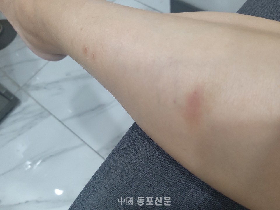 남편이 때려서 피가 났다는 다리다. 그러나 폭력을 당했다며 허위 신고한 외국인 여성 다리 사진